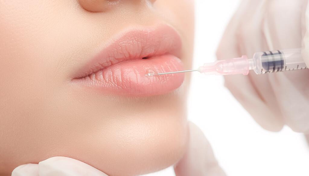Aplicação de ácido hialurônico nos lábios para preenchimento e harmonização facial